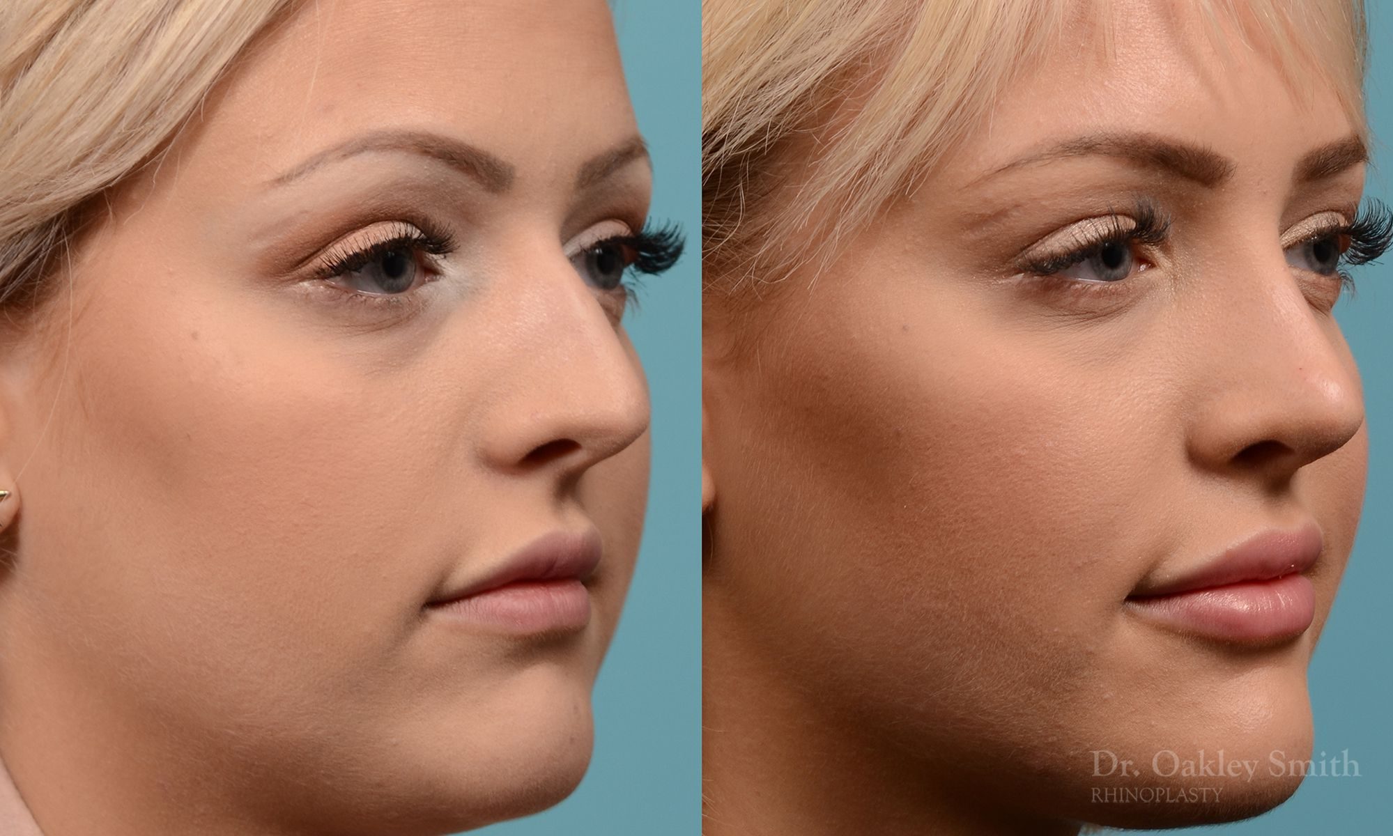 Hump removal and straightening