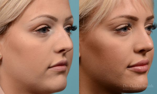 Hump removal and straightening