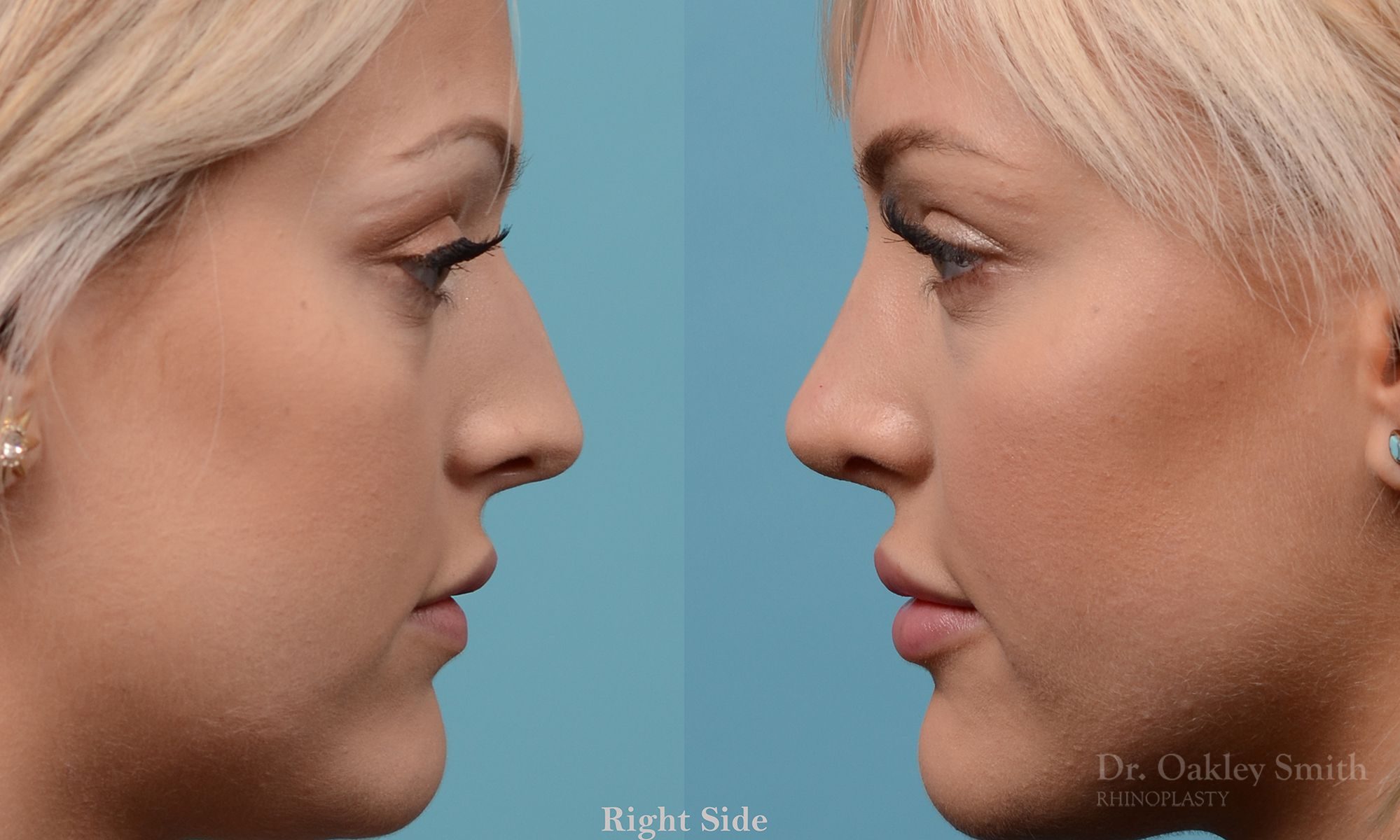 Rhinoplasty Dr Oakley Smith Surgeon