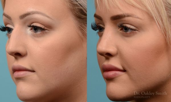 Hump removal and straightening