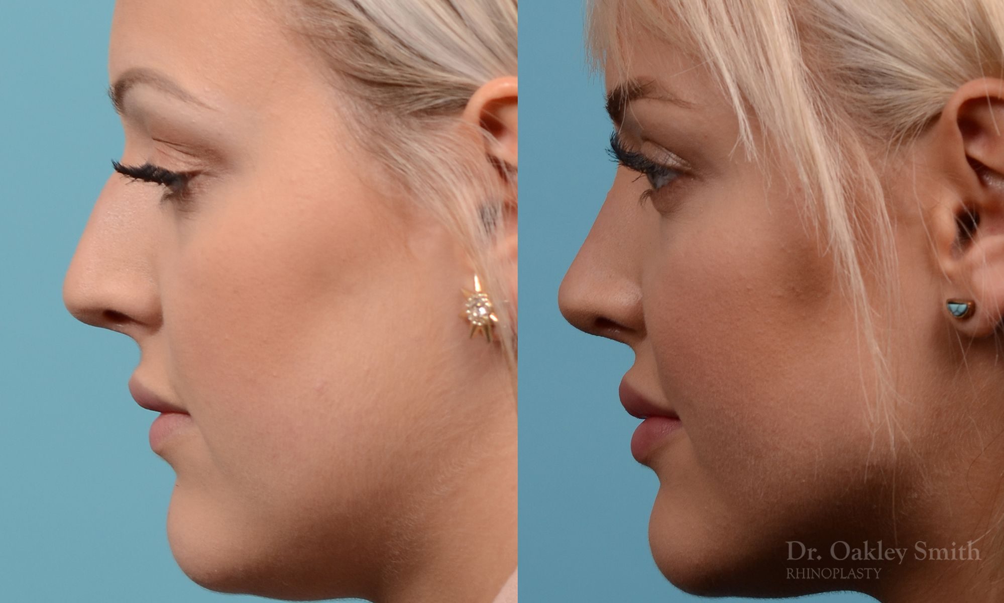 Hump removal and straightening