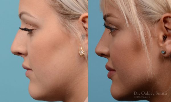 Hump removal and straightening