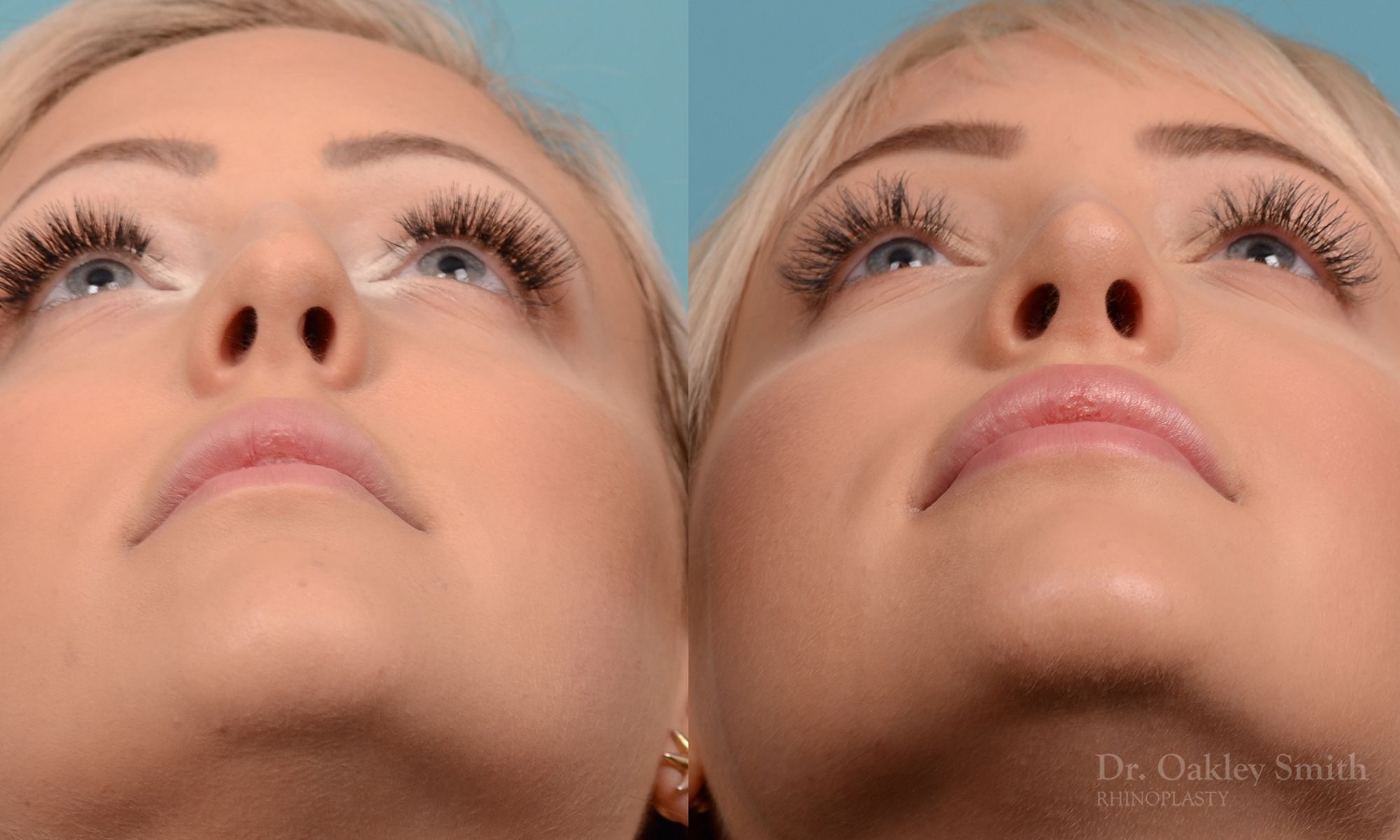 Hump removal and straightening