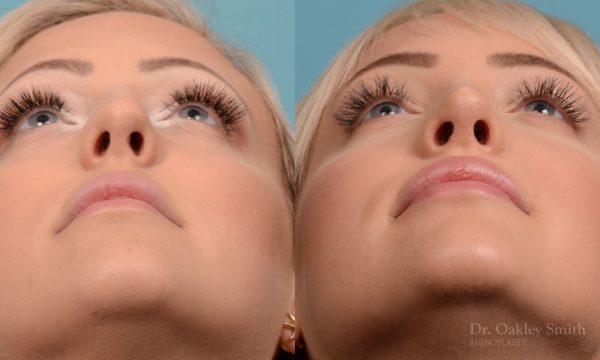 Hump removal and straightening
