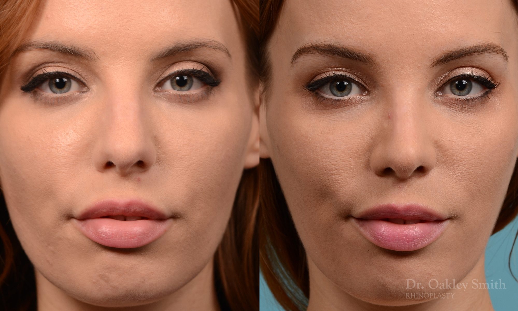 Rhinoplasty nose surgery to shorten her nose