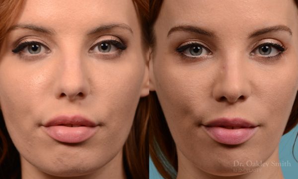 Rhinoplasty nose surgery to shorten her nose