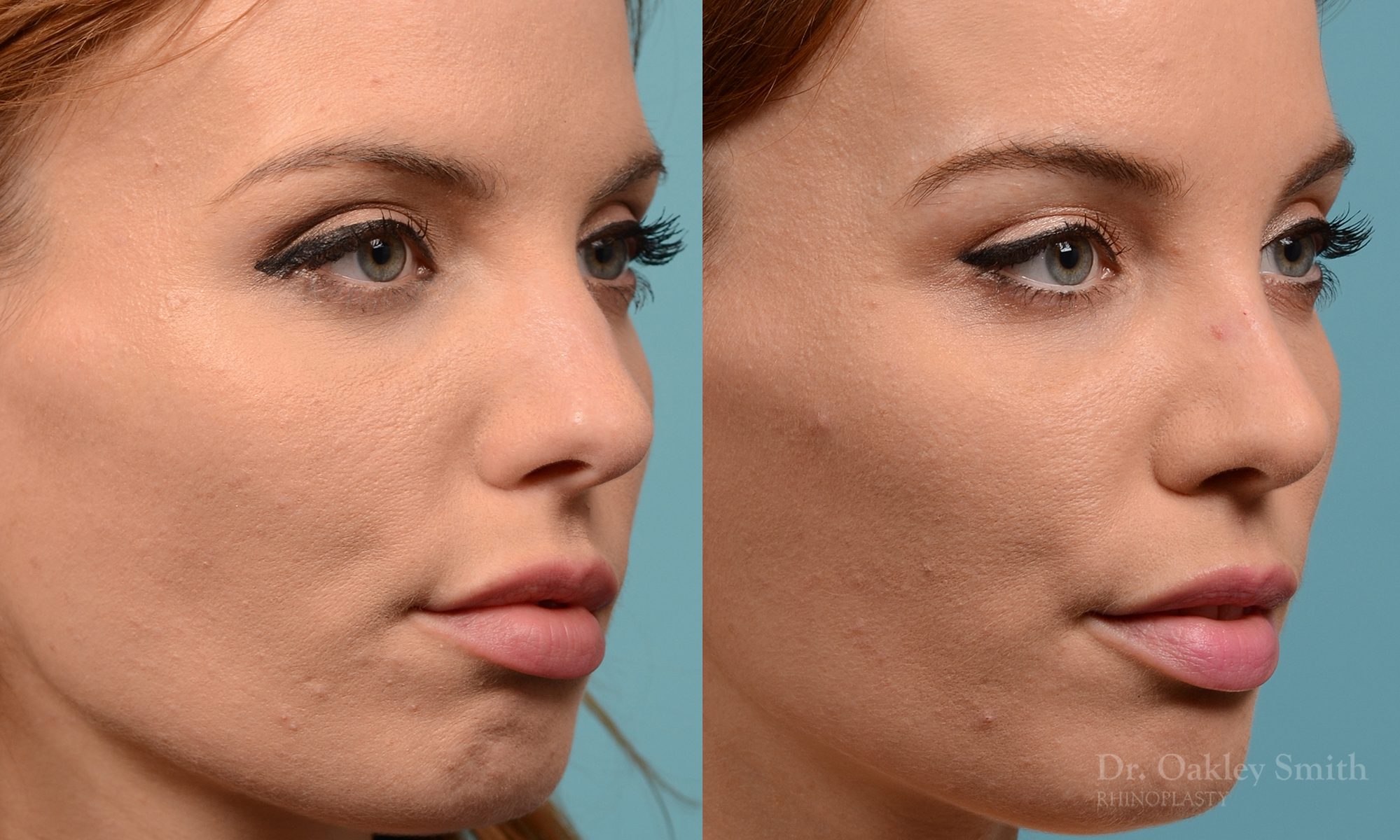 Rhinoplasty nose surgery to shorten her nose