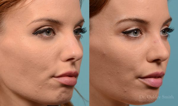 Rhinoplasty nose surgery to shorten her nose