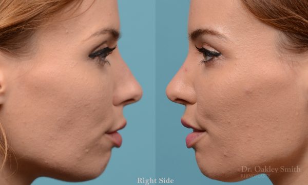 Rhinoplasty nose surgery to shorten her nose