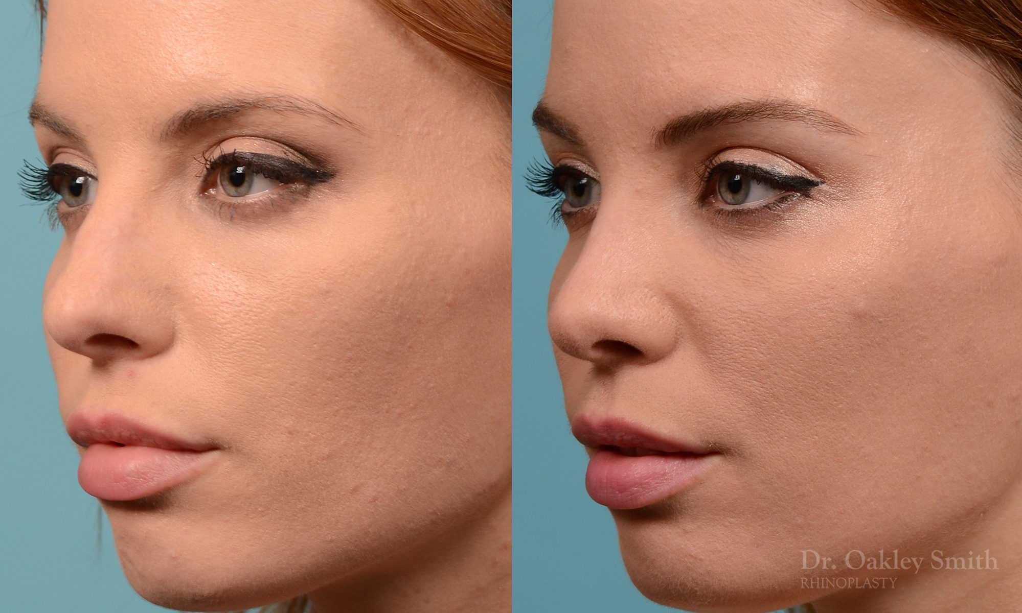 Rhinoplasty nose surgery to shorten her nose