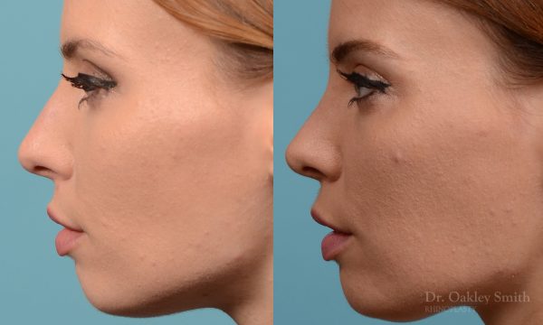 Rhinoplasty nose surgery to shorten her nose