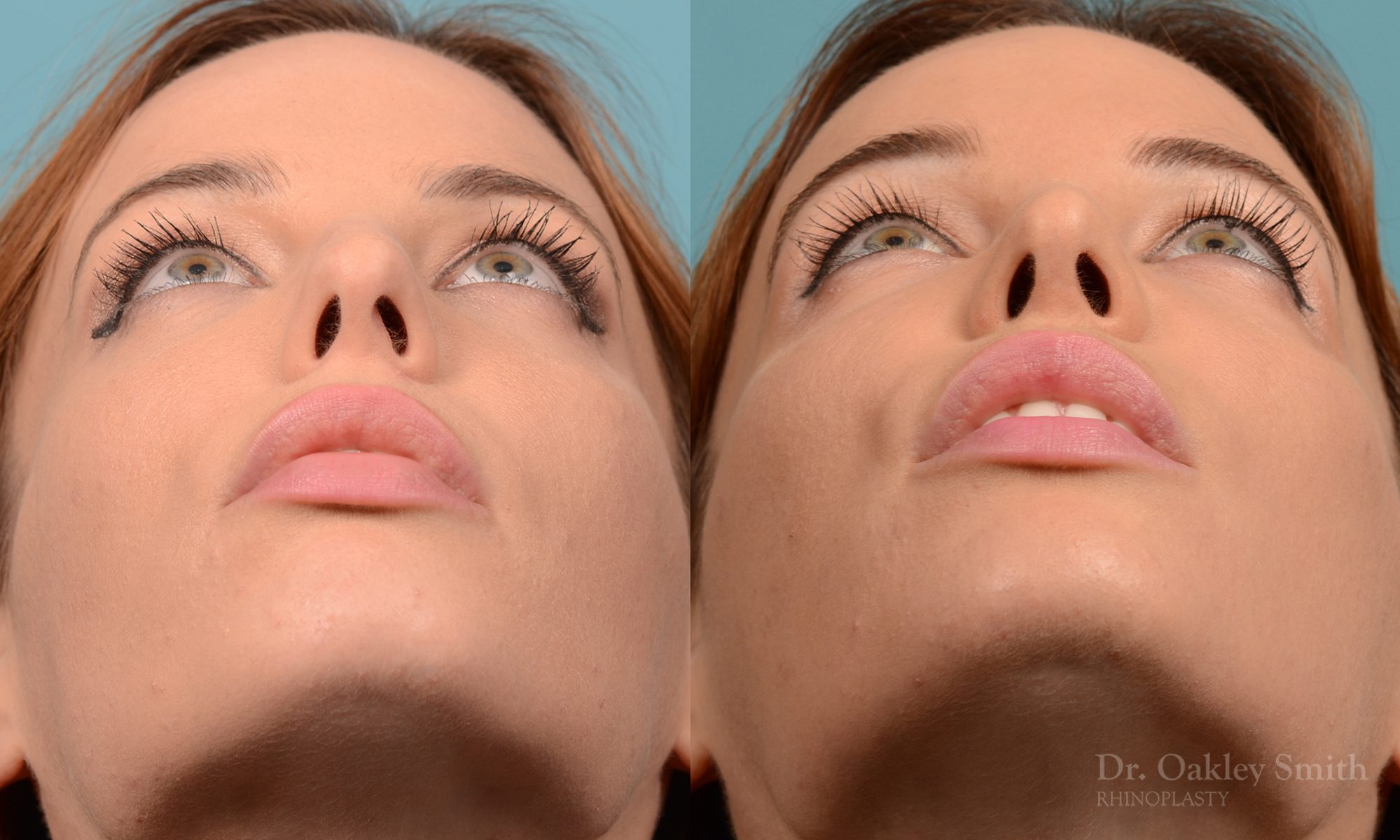 Rhinoplasty nose surgery to shorten her nose