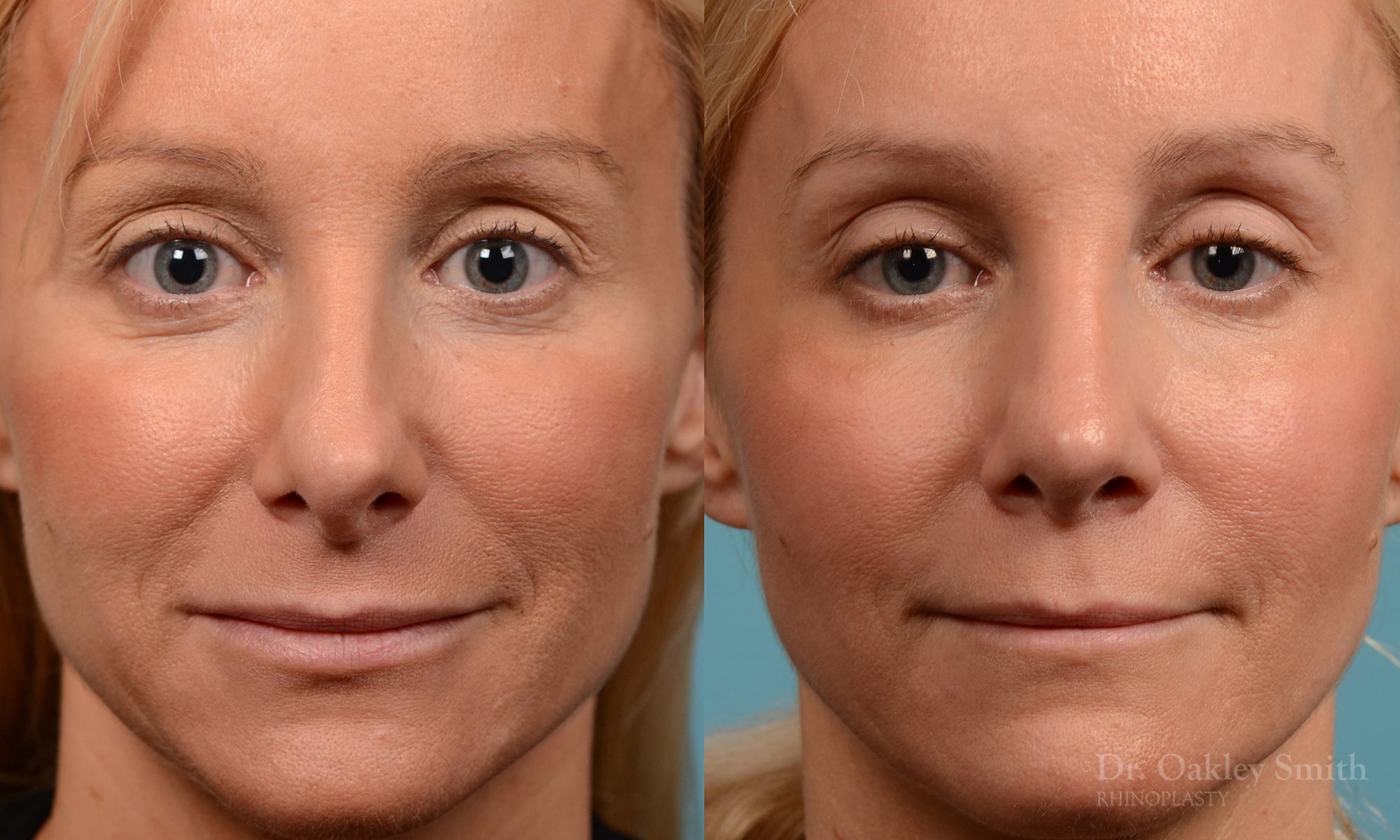 rhinoplasty