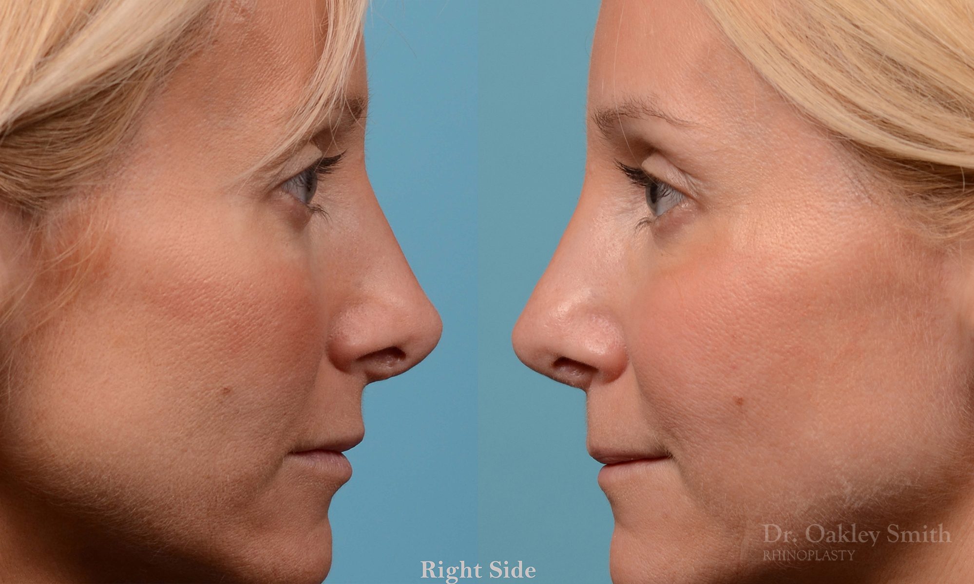 rhinoplasty