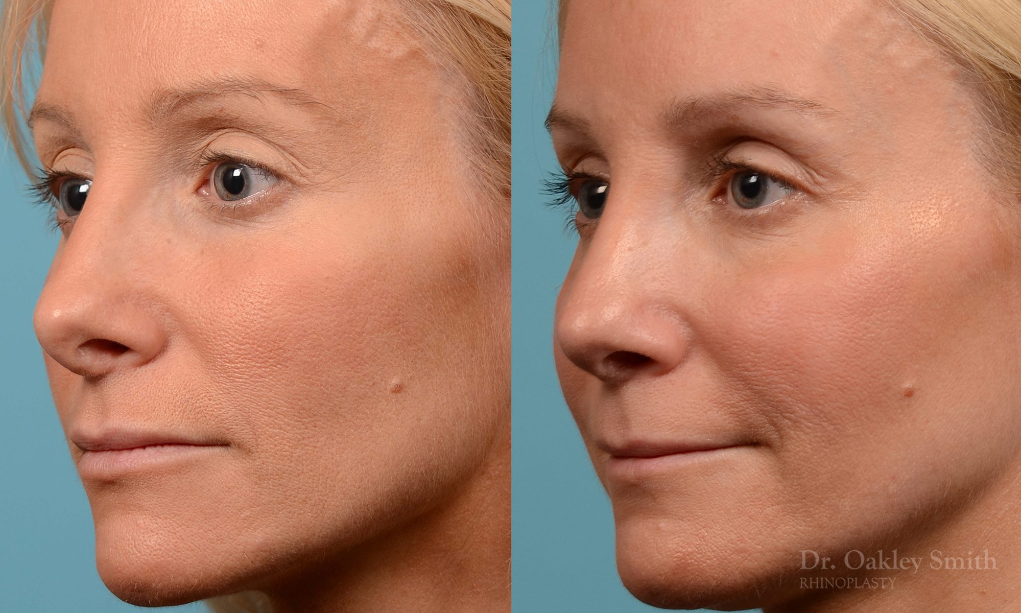 rhinoplasty