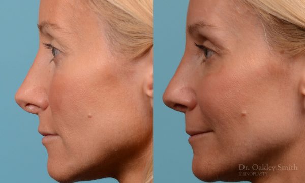 rhinoplasty