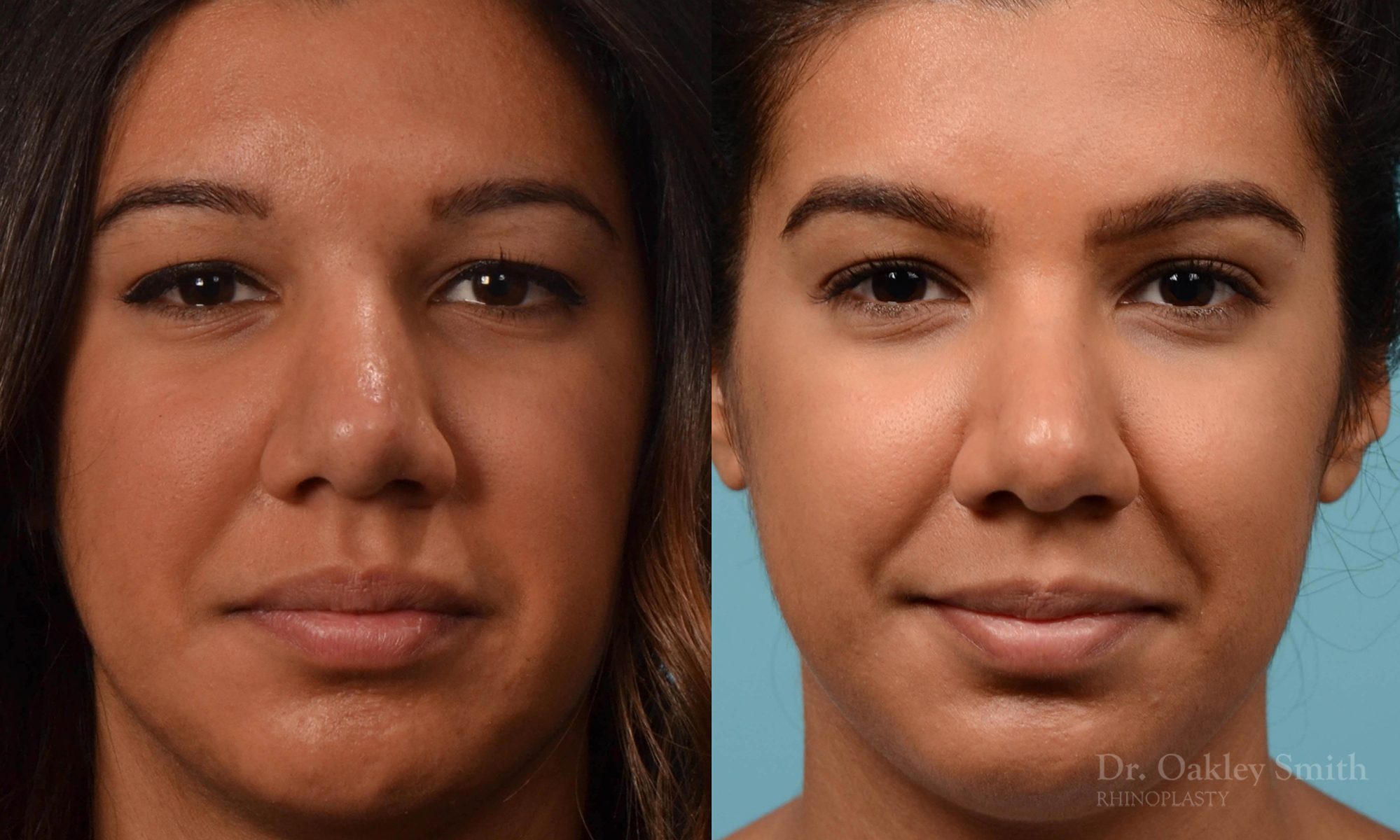 rhinoplasty defined nose