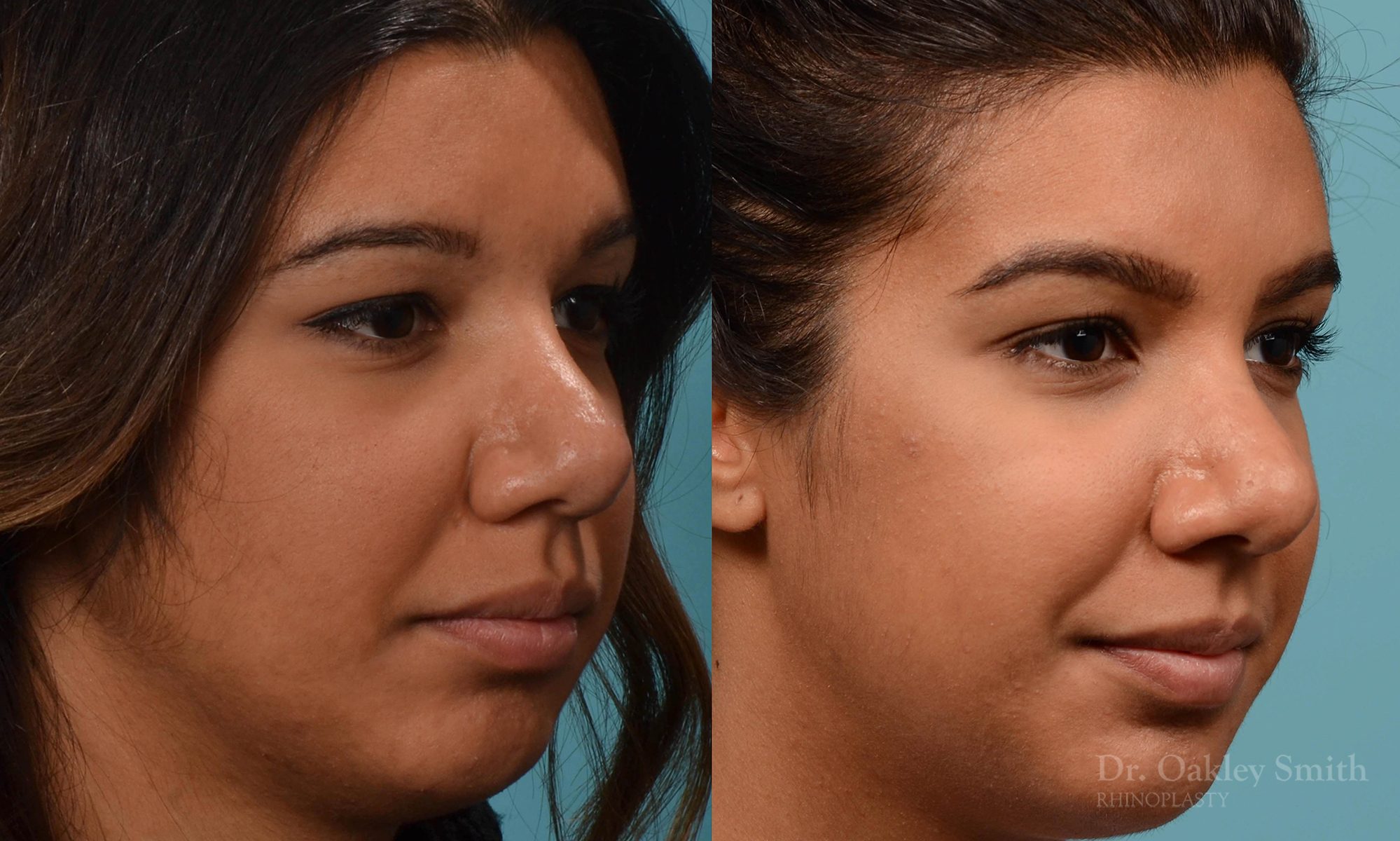 rhinoplasty defined nose