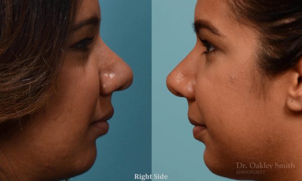 rhinoplasty defined nose