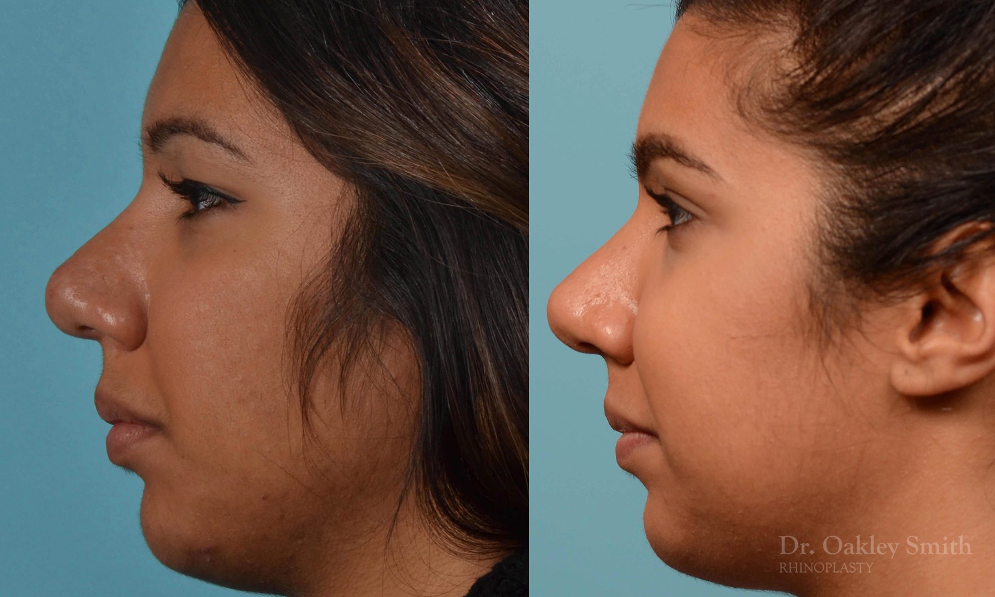 rhinoplasty defined nose