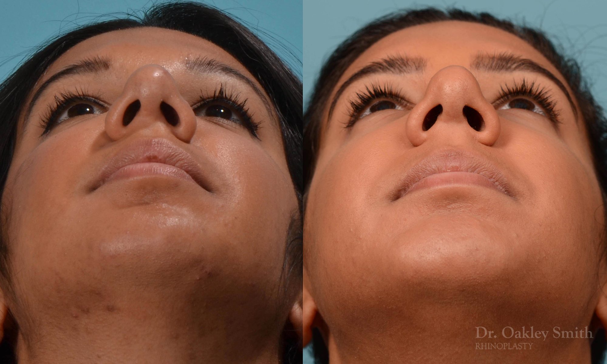 rhinoplasty defined nose