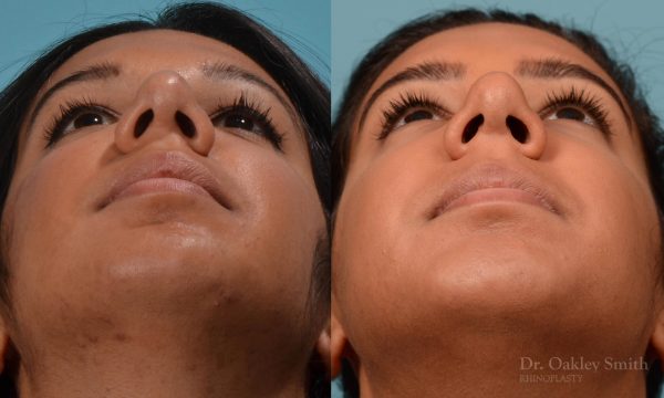 rhinoplasty defined nose
