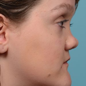 rhinoplasty smooth tip