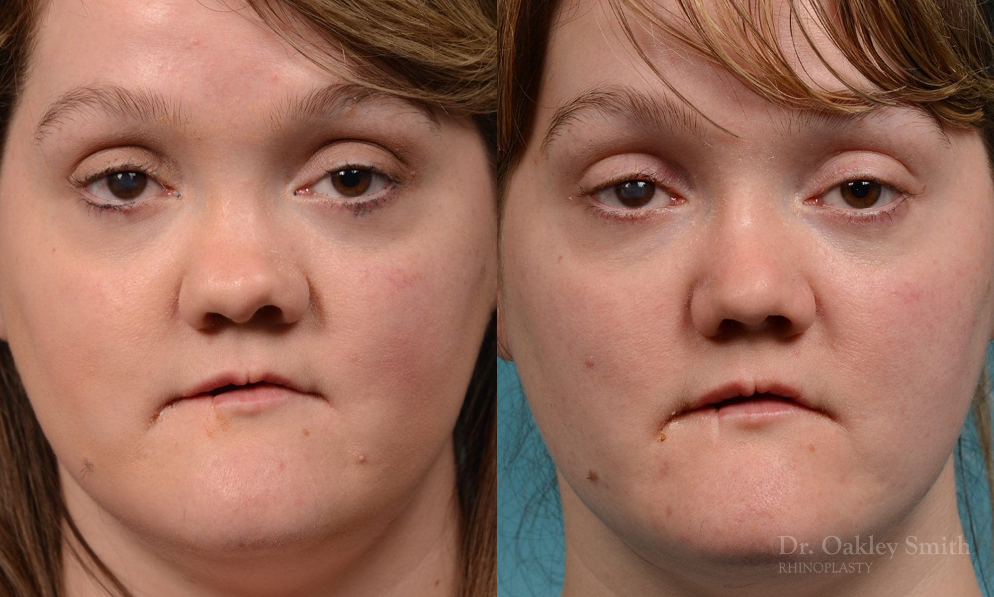 rhinoplasty smooth tip
