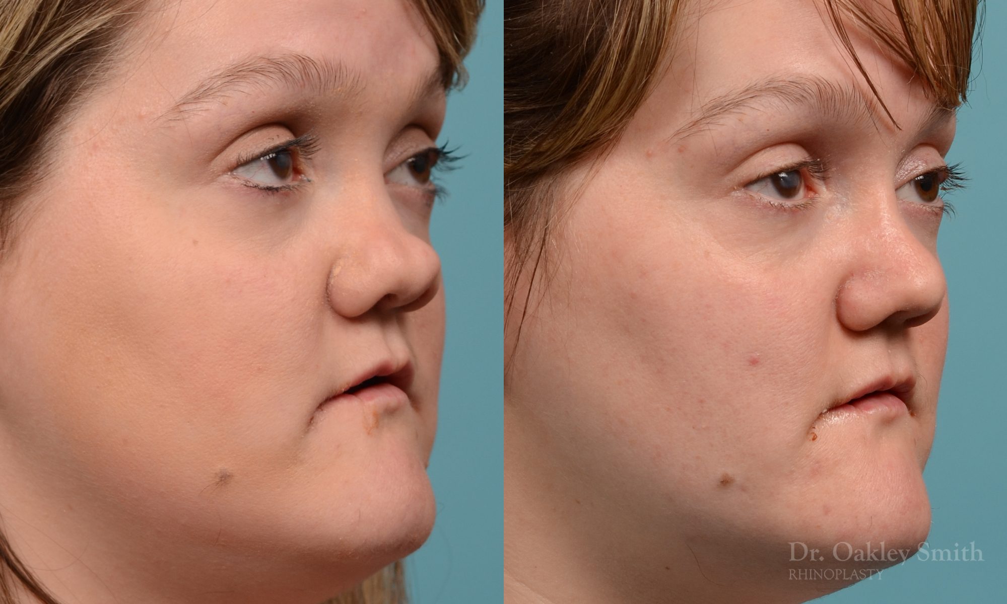 rhinoplasty smooth tip