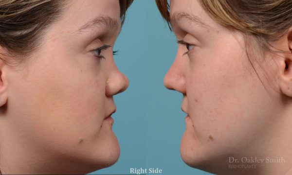 rhinoplasty smooth tip