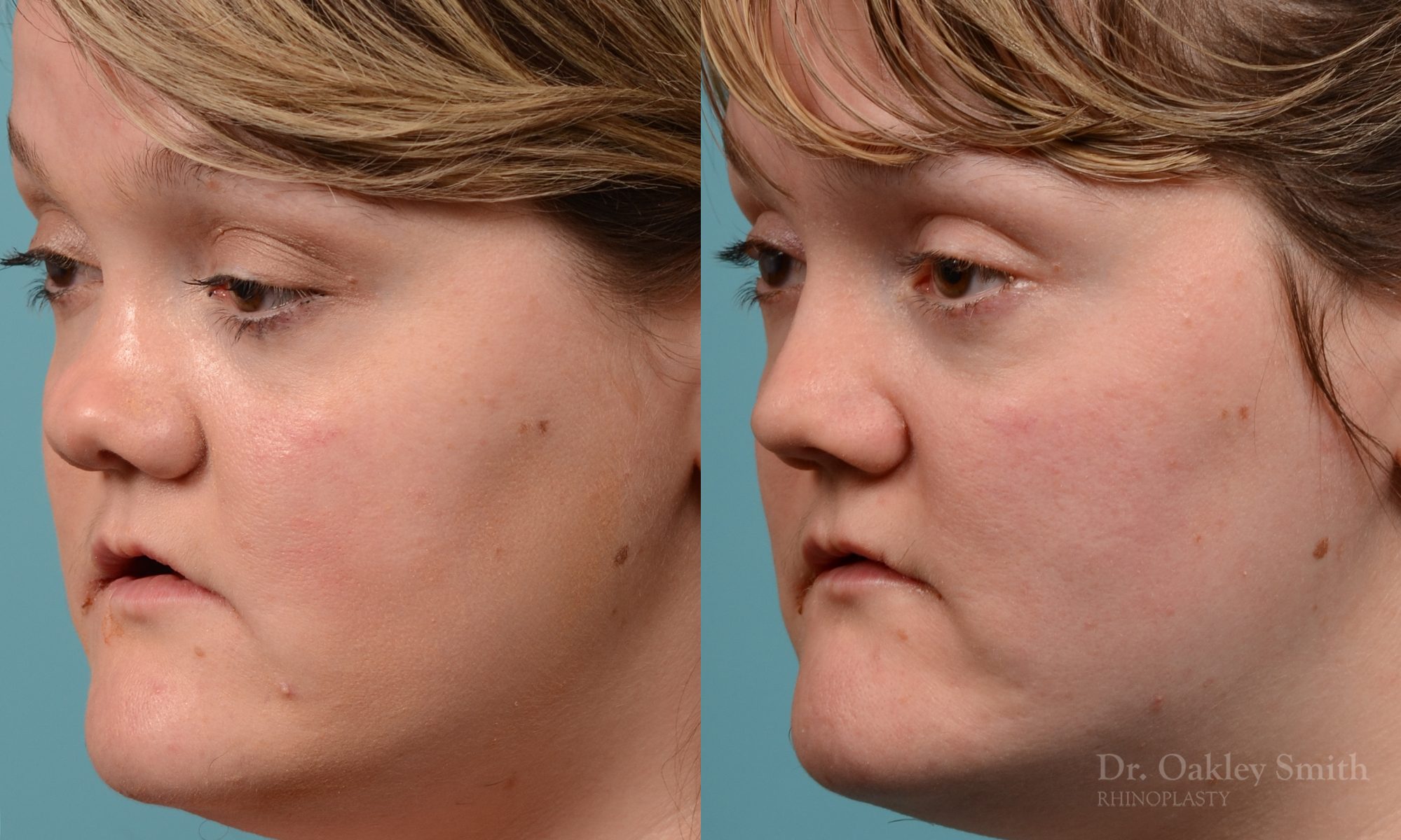 rhinoplasty smooth tip