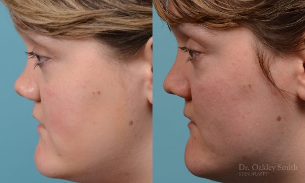 rhinoplasty smooth tip
