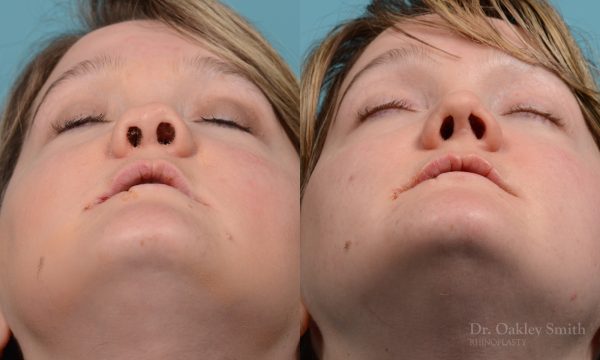 rhinoplasty smooth tip