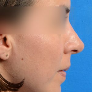 Revision Rhinoplasty, Rhinoplasty - Rhinoplasty Before and After Case 221