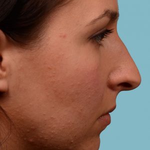 Rhinoplasty hum reduction surgery on female