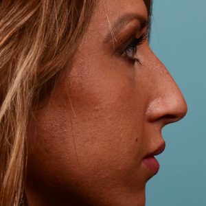 Nose surgery for hump reduction
