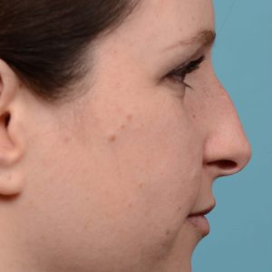rhinoplasty nose surgery on female