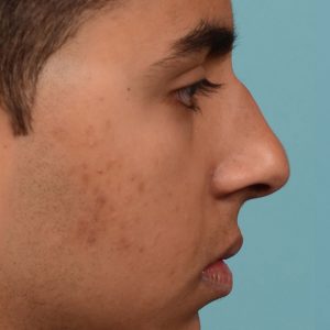 Hump reduction rhinoplasty on young male
