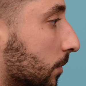 Rhinoplasty hump reduction