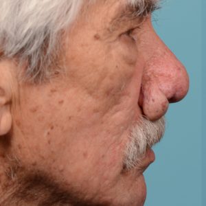 Rhinophyma on elderly man