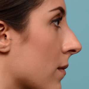 Rhinoplasty surgery to create a smoother bridge