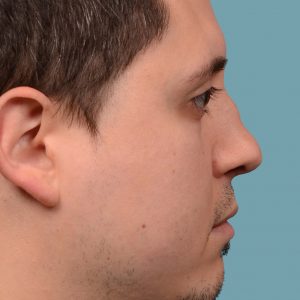 rhinoplasty