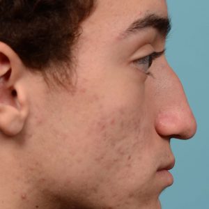 Broken nose rhinoplasty