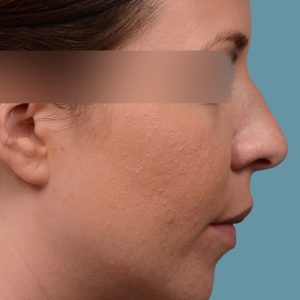 female rhinoplasty and hump reduction