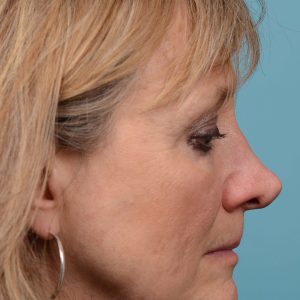 Rhinoplasty to smooth out her nose