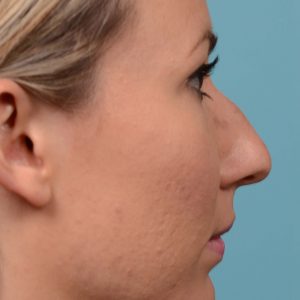 rhinoplasty bump removal