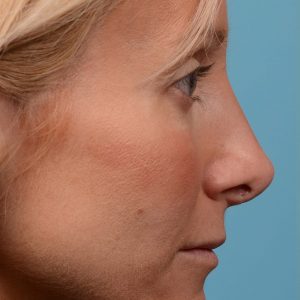 rhinoplasty