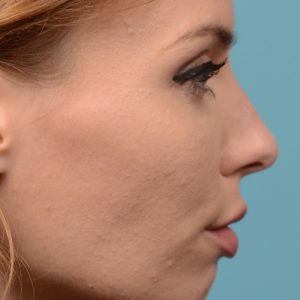 Rhinoplasty nose surgery to shorten her nose
