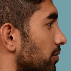 rhinoplasty