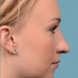 rhinoplasty